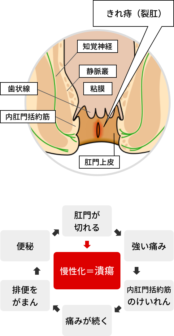 痔の治療～身近に潜むお尻の疾患～ | ファミリー薬局