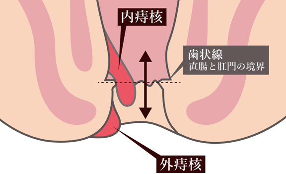 オロナイン / オロナインＨ軟膏 (医薬品)の口コミ（by mirai0351さん