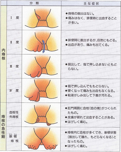 痔の薬はどれがいい？痔に効く外用薬と内服薬の選び方を解説 | お薬専門通販のミナカラ｜オンライン薬局