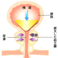 前立腺の病気