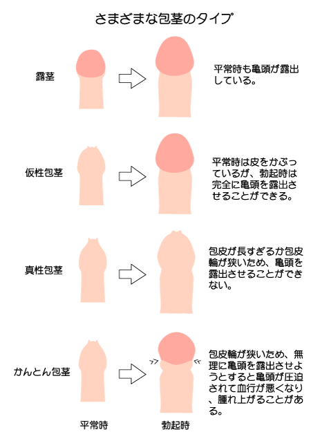 医師監修】包茎(ほうけい)だとセックスに支障が？包茎の種類別、セックスにおけるトラブルについて解説！ | メンズライフクリニック【公式】