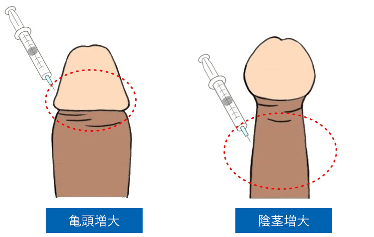 陰茎脂肪注入 ： 男性器（包茎、長茎など）：美容外科