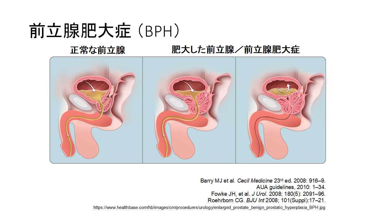 前立腺肥大症の原因や症状、治療方法 | 四谷メディカルキューブ