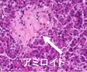 再発又は難治性の多発性骨髄腫 エロツズマブ 希少疾病用医薬品指定