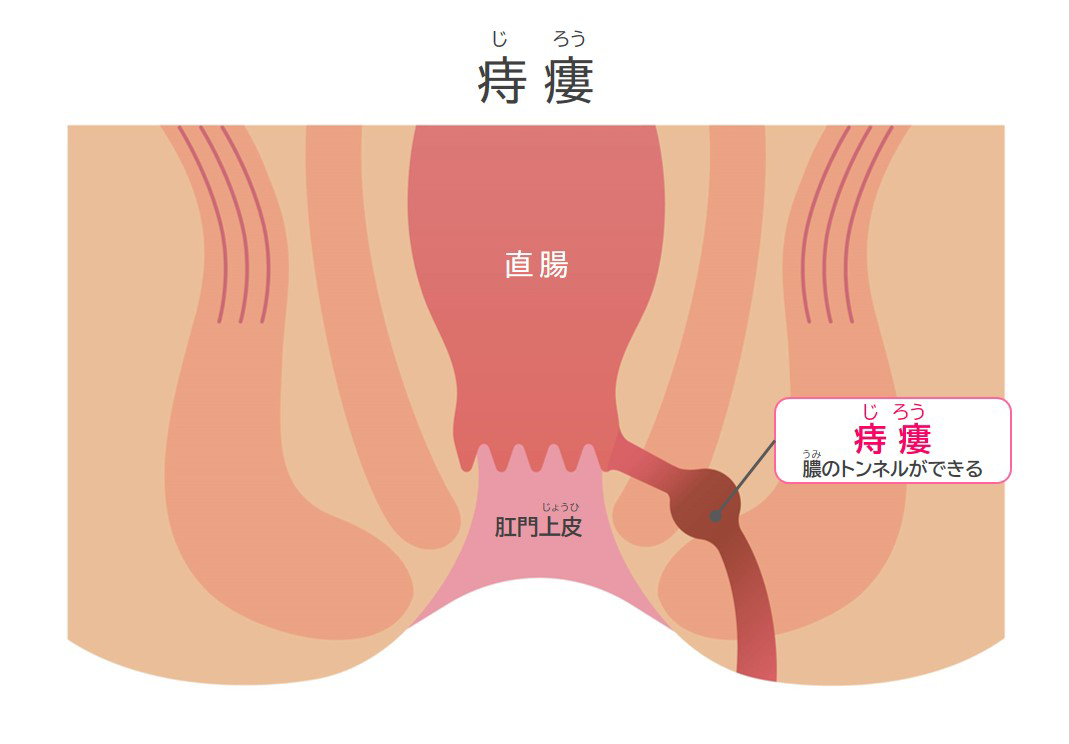 痔ろう（あな痔）と肛門周囲膿瘍 | 岡外科胃腸肛門科