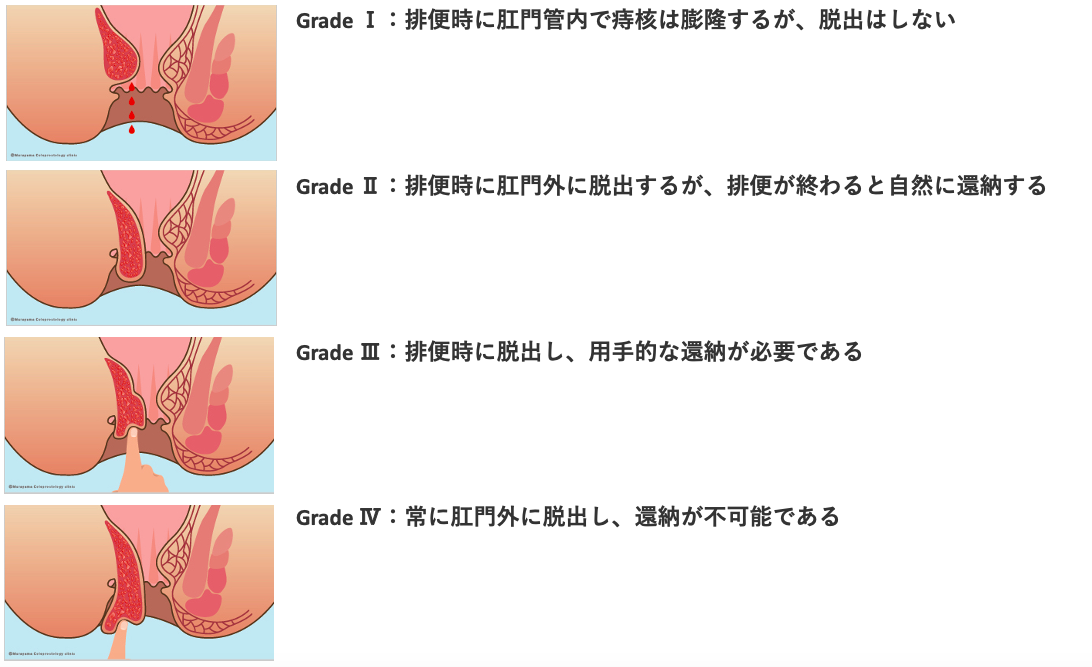 痔の症状・原因｜くすりと健康の情報局