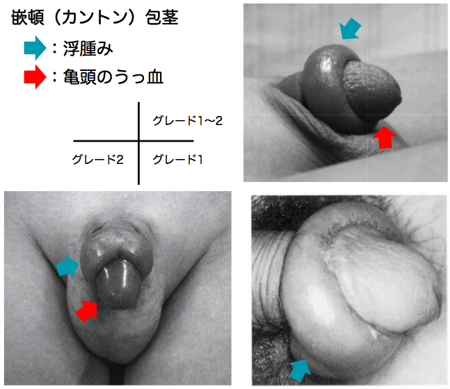 真性包茎手術なら美容形成専門のMSクリニック【新宿】