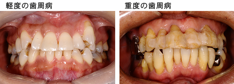 子どもの歯並びが悪くなる原因とその後の影響・治療方法について – 戸田市の小児歯科｜北戸田COCO歯科