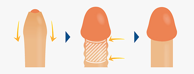 カリ高ペニスが持つ4つのメリットとカリ高になる方法・手術費用を解説 | 包茎手術のノーストクリニック【公式】
