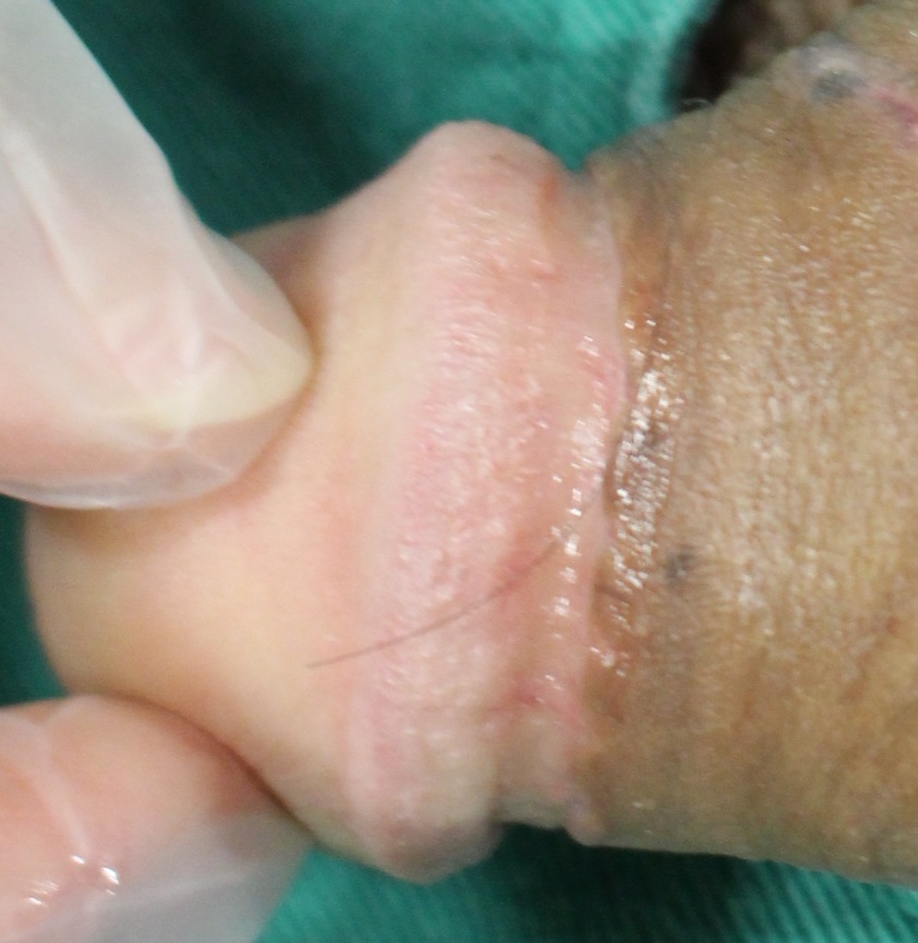 包茎患者さんに多い真珠様陰茎小丘疹（Pearly Penile Papules）: