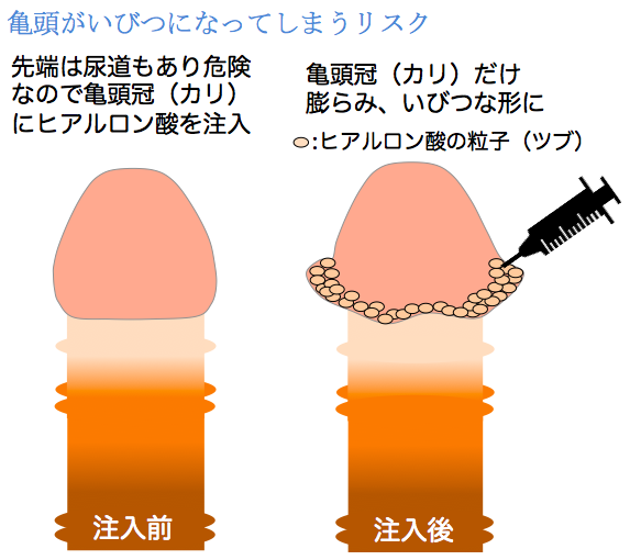 早漏防止治療 | エーツークリニック