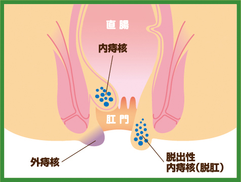 頑固な便秘や“こすりすぎ”に注意！お尻のトラブル対策 | サワイ健康推進課