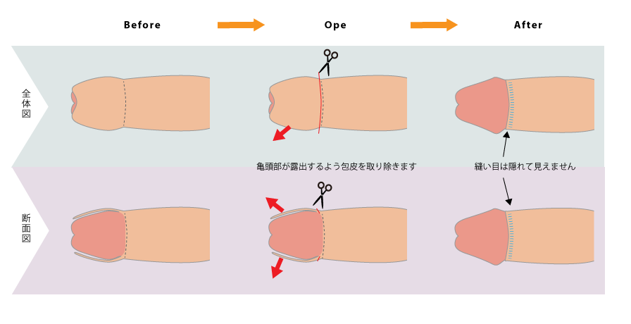 包茎の問題｜包茎・ED治療など男性形成なら銀座みゆき通り美容外科 東京銀座・大阪梅田