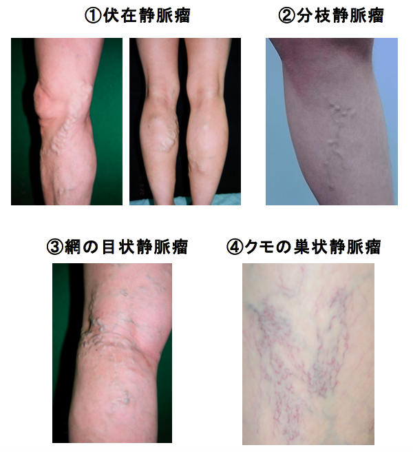浦和・北浦和・南浦和で下肢静脈瘤の治療ならアキ循環器・血管外科クリニック