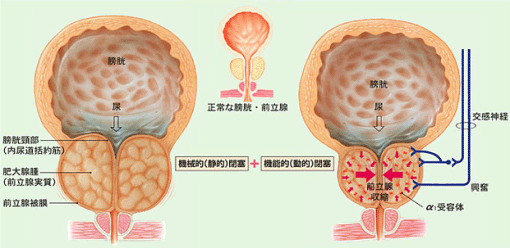 前立腺炎や前立腺肥大で「早漏」になった人の正しい治療法｜あんしん通販コラム