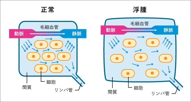 知ってください下肢静脈瘤のこと ｜ 下肢静脈瘤の治療法