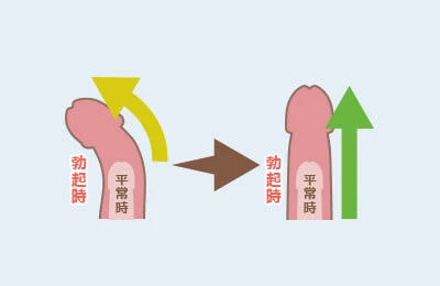 泌尿器科の専門医が徹底解説】ペニスの曲がりは治療が必要？原因・リスク・治療法まで