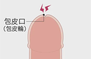 真性包茎とは？治療方法 | マンモスクリニック