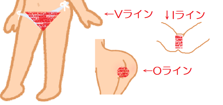 医師監修】VIO脱毛のときのかゆみ、どうしたらいいですか？｜フェミニーナ｜小林製薬