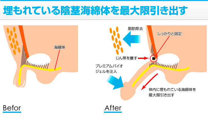 長茎治療（ペニスを長く）｜札幌中央クリニック