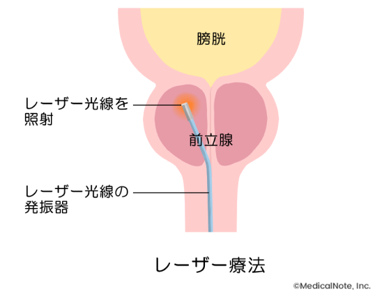 慢性前立腺炎｜神戸市東灘区 摂津本山｜いしむら腎泌尿器科クリニック