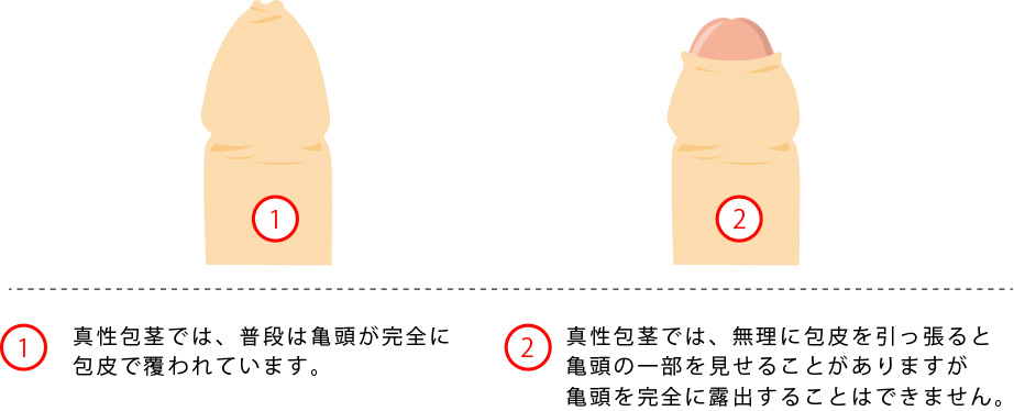 包茎がセックスに与える5つの影響！代表的な悩み＆注意点と治療法 - アトムクリニック - atom-clinic