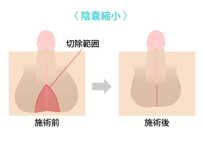 長茎手術（切らない・切る）-東郷美容形成外科 福岡メンズ-福岡・博多で包茎手術・亀頭増大・陰茎増大・長茎治療なら