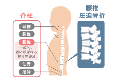 後縦靭帯骨化症（こうじゅうじんたいこっかしょう）とは｜関節とは | 人工関節と関節痛の情報サイト