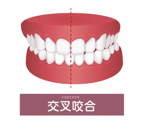 笑ったときに影ができる…バッカルコリドー（バッカルコリダー）って知ってる？ | 埼玉県の矯正歯科情報サイト「オルソペディア」