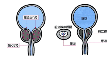 産業医科大学｜北九州市内初！前立腺肥大症の経尿道的水蒸気治療（WAVE治療）が可能となりました