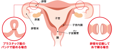 避妊法について― リプロダクティブ・ヘルス＆ライツ（性と生殖の健康と権利）の観点より―｜京都済生会病院