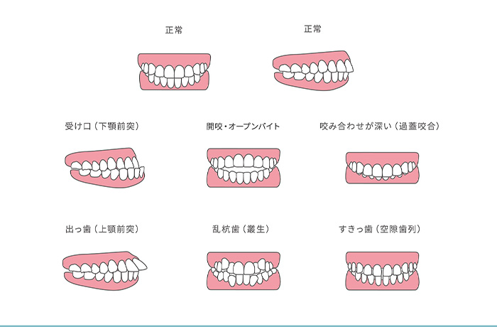 矯正は小さい頃からする方がいいの？