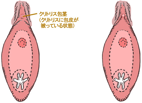 女性の包茎とは？クリトリス包茎における一般的な悩みと対処法 - アトムクリニック -