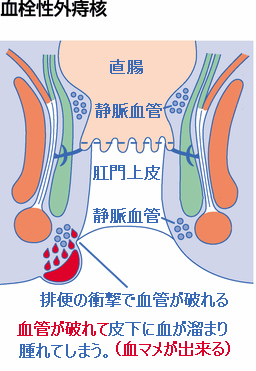 きれ痔（裂肛）の特徴｜ボラギノール公式ブランドサイト