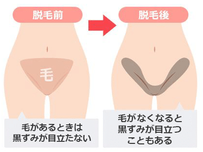 VIO脱毛後にかゆみや痛みを感じる原因は？予防法と対処法を解説｜脱毛・ニキビ治療・ダイエットのイデア美容皮膚科クリニック【柏・船橋・錦糸町】