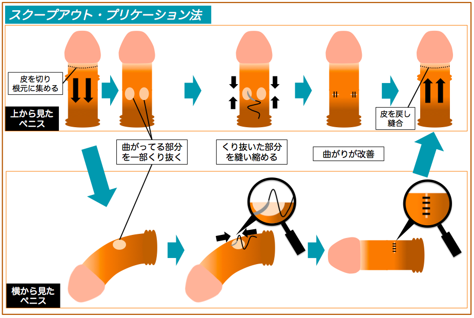 症例写真付】ペニスのねじれは修正可能！術後の痛みもほぼ無し！