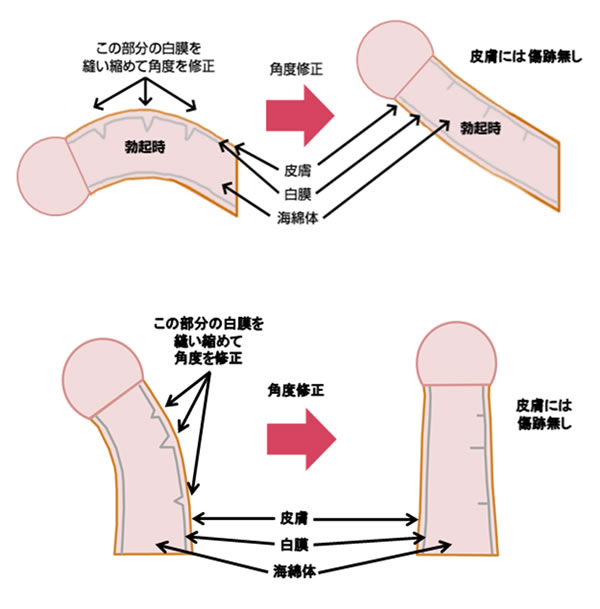 泌尿器科の専門医が徹底解説】ペニスの曲がりは治療が必要？原因・リスク・治療法まで