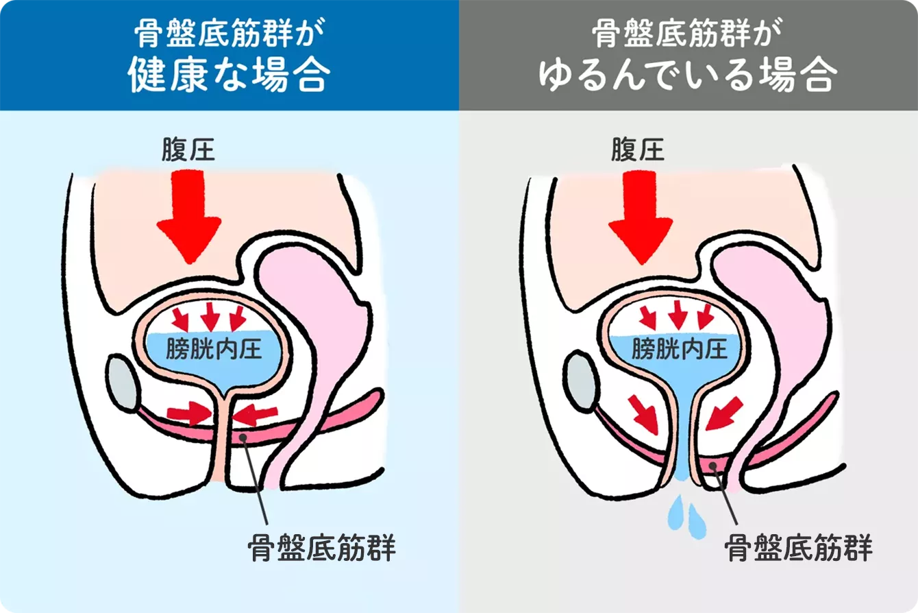 女性泌尿器疾患・骨盤臓器脱（尿もれ、頻尿、性器脱） | 女性の健康推進室 ヘルスケアラボ｜厚生労働省研究班監修