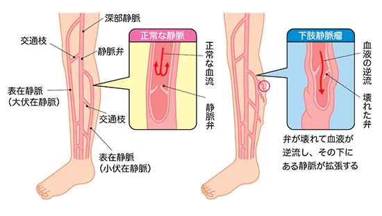 くるぶしに糸ミミズのような細かい血管が気になったら