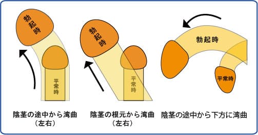 下曲り（下向き） に曲がった男性器（ペニス）の治療症例 | 症例写真・体験談｜包茎・ED治療など男性形成なら銀座みゆき通り美容外科