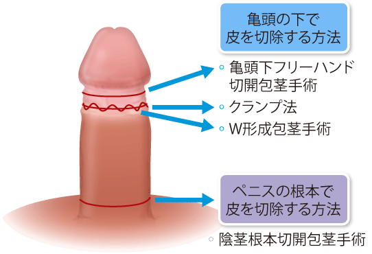 仮性包茎で皮余る現象｜原因と解決策を徹底解説