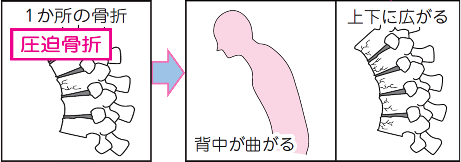 骨粗鬆症の治療｜【小倉 卓】脊椎圧迫 骨折に対する保存療法では改善が難しいという患者さんには、負担が軽くて早期の改善が見込める最新の手術で、痛みから早く解放し、助けてあげたいと考えています。