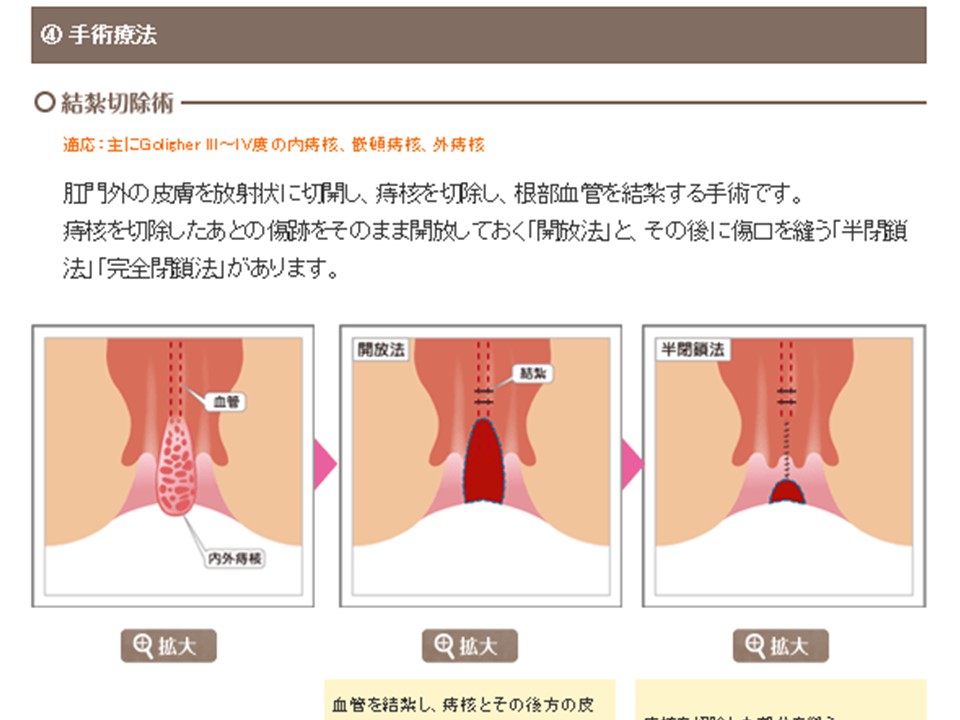 誰にも聞けない“痔(じ)”の悩み「解決!“切れ痔(じ)”と“痔(じ)ろう”」 - きょうの健康 - NHK