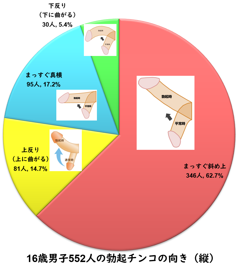 男性器（ペニス）が下向きや左右に曲がっている症状を真っ直ぐに。日帰り治療できます｜包茎・ED治療など男性形成なら銀座みゆき通り美容外科  東京銀座・大阪梅田