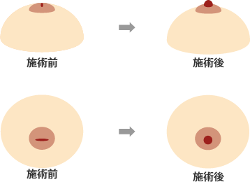 乳頭や乳輪の黒ずみを手軽に改善するニップルアートメイクとは - トイトイトイクリニック