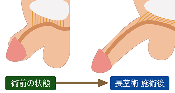 陰茎増大(サオを太く長く) | ペニス増大 | 男性泌尿器科【金沢中央クリニック】