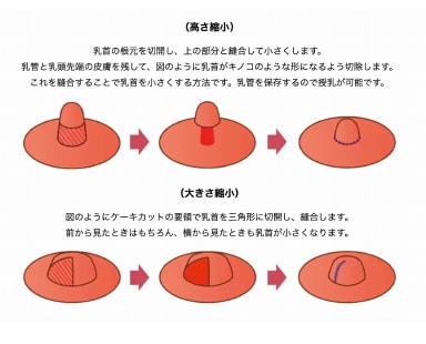 仮性陥没乳頭はどうやって治す？症状・治療方法を詳しく解説 | 大阪（心斎橋、梅田）・福岡（博多）の美容皮膚科・美容外科・メンズクリニックはWクリニックへ