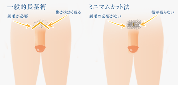 ペニスの構造と包茎の特徴｜包茎の手術や治療は認定専門医に！[東京・大阪]