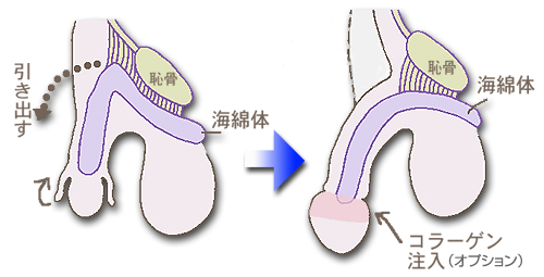 長茎術（ペニスを長くする）なら新宿形成外科