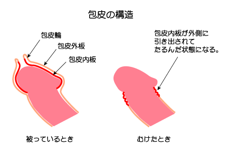 仮性包茎とは？症状・治し方等について｜MSクリニック